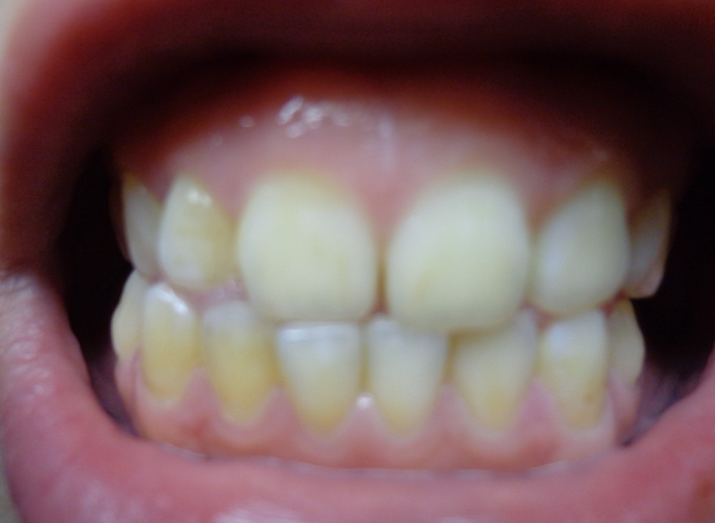牙齿黄