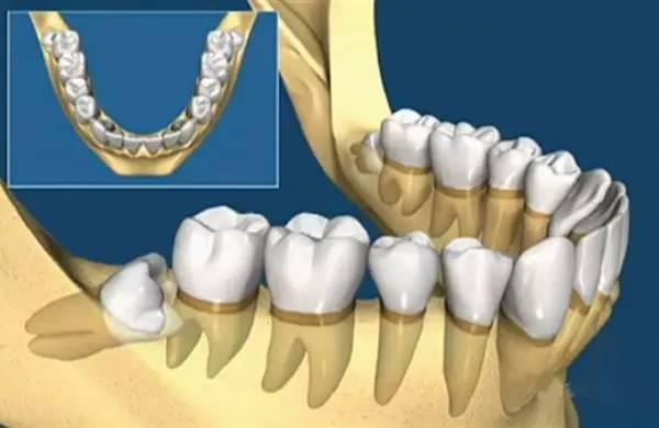 我們在吃飯時很少能夠用到智齒,而智齒的萌出常常給清潔牙齒帶來麻煩.